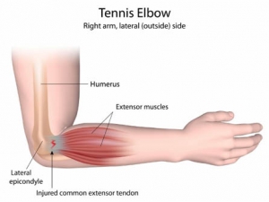 Tennis Elbow - Physio Leeds
