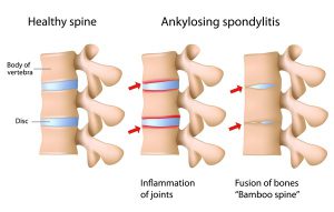 Ankylosing Spondylitis Treatment - Physio Leeds